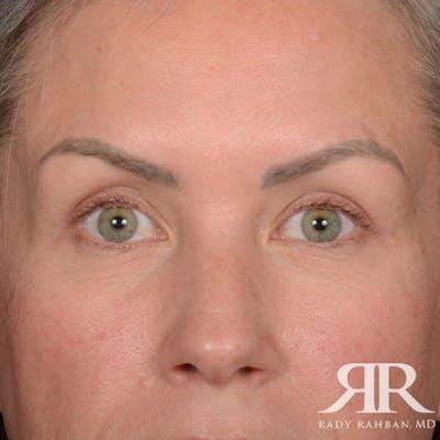 Dr. Rady Rahban blepharoplasty after — Beverly Hills, CA