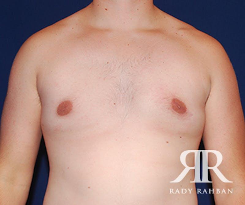 Dr. Rady Rahban gynecomastia after — Beverly Hills, CA