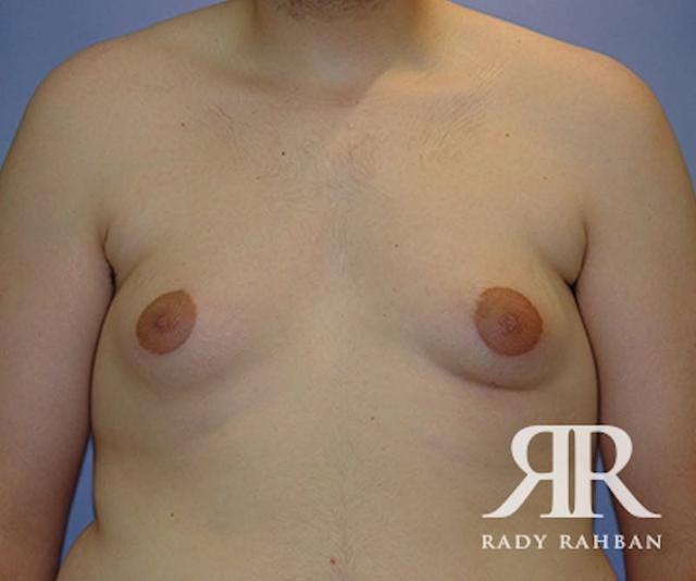 Gynecomastia Surgery before at Dr. Rady Rahban in Beverly Hills, CA