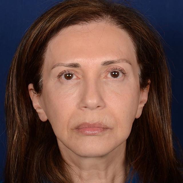 Facelift after at Dr. Rady Rahban in Beverly Hills, CA