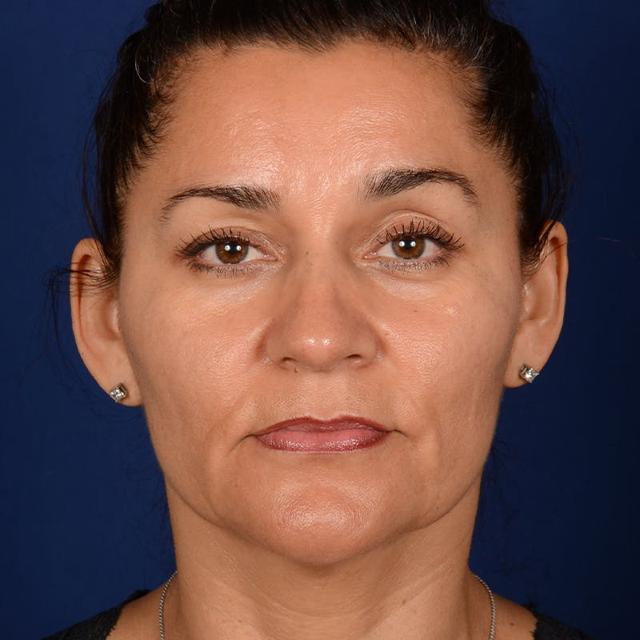 Facelift before at Dr. Rady Rahban in Beverly Hills, CA