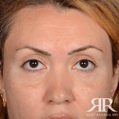 Dr. Rady Rahban blepharoplasty after — Beverly Hills, CA