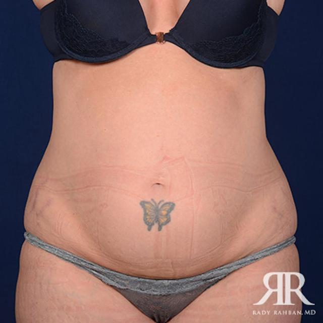 Tummy Tuck before at Dr. Rady Rahban in Beverly Hills, CA