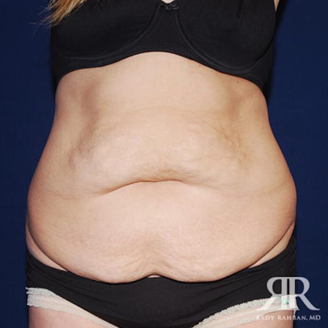 Tummy Tuck before at Dr. Rady Rahban in Beverly Hills, CA