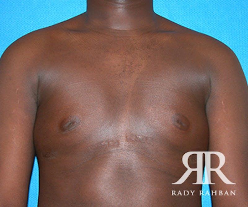 Dr. Rady Rahban gynecomastia after — Beverly Hills, CA