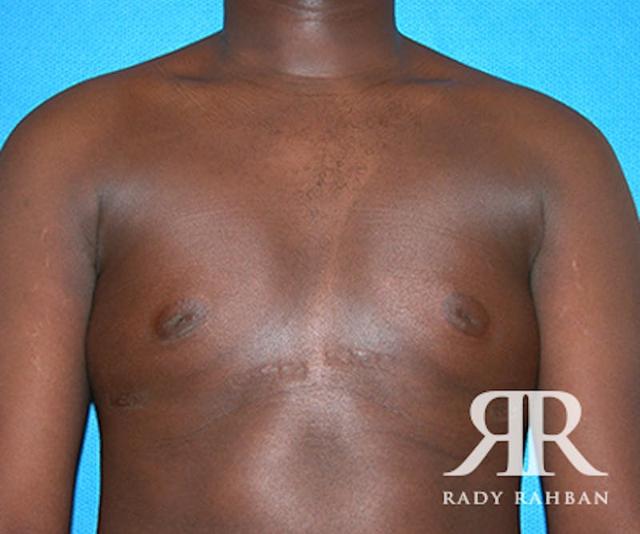 Gynecomastia Surgery after at Dr. Rady Rahban in Beverly Hills, CA
