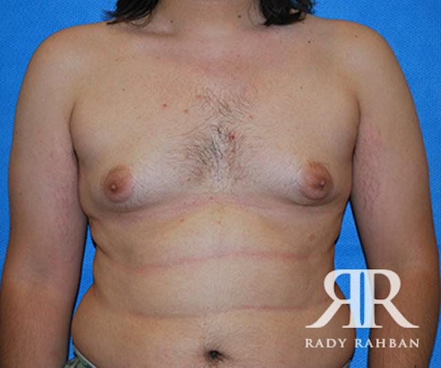 Gynecomastia Surgery before at Dr. Rady Rahban in Beverly Hills, CA