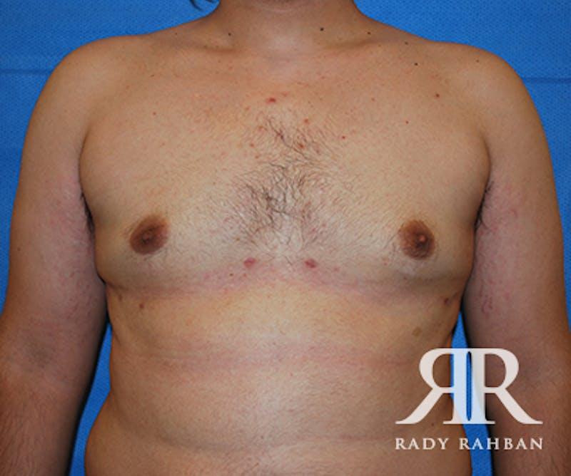 Dr. Rady Rahban gynecomastia after — Beverly Hills, CA