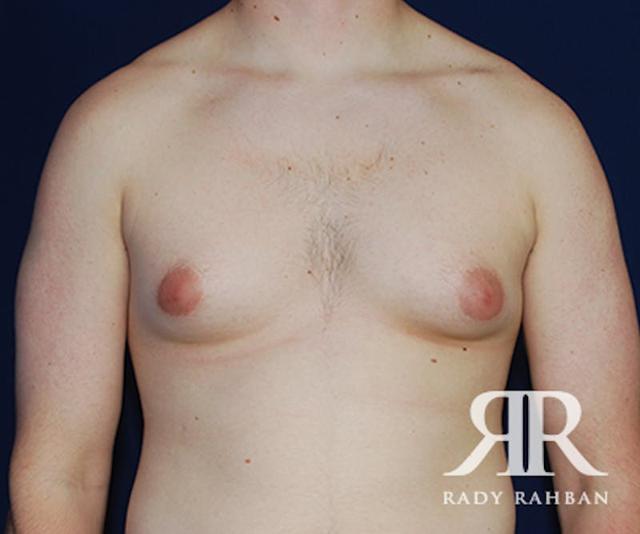 Gynecomastia Surgery before at Dr. Rady Rahban in Beverly Hills, CA