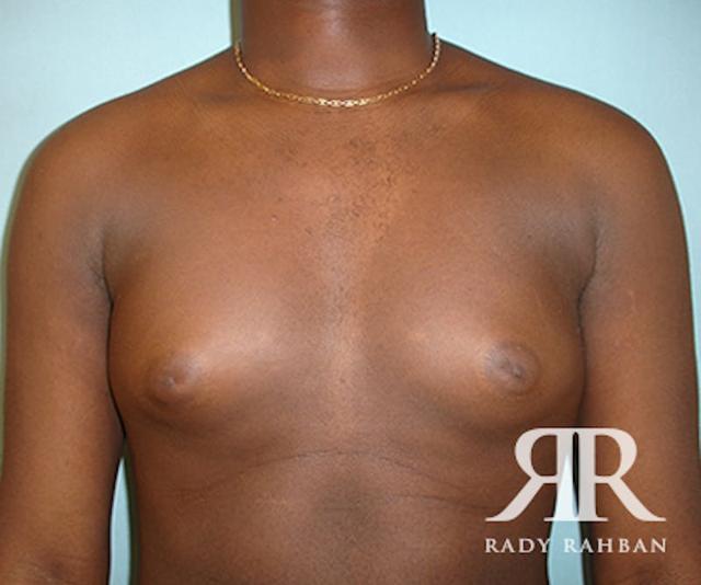 Gynecomastia Surgery before at Dr. Rady Rahban in Beverly Hills, CA