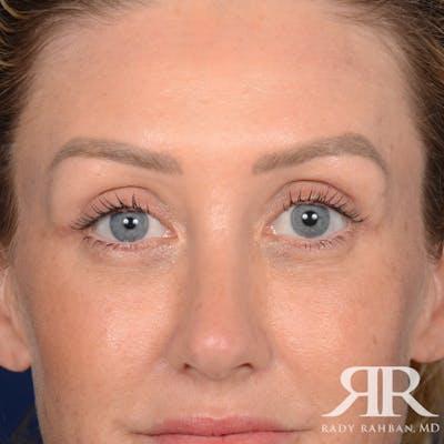 Dr. Rady Rahban blepharoplasty after — Beverly Hills, CA