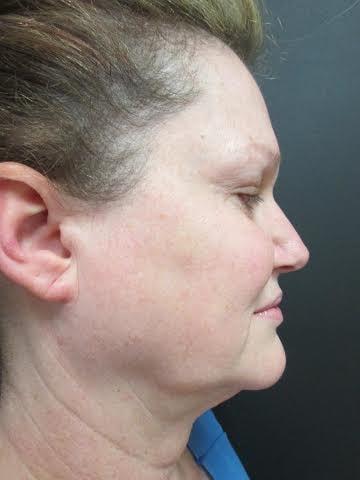Facelift before at Los Angeles Center for Cosmetic Surgery in Los Angeles, CA