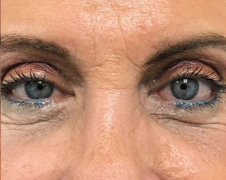 Los Angeles Center for Cosmetic Surgery eyelid lift after — Los Angeles, CA