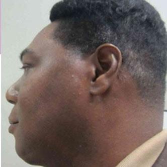 Chin Implant after at Los Angeles Center for Cosmetic Surgery in Los Angeles, CA