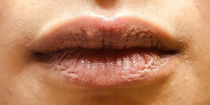 Los Angeles Center for Cosmetic Surgery lip filler after — Los Angeles, CA