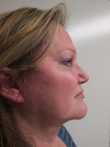 Facelift after at Los Angeles Center for Cosmetic Surgery in Los Angeles, CA
