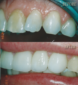 Invisalign result at Colorado Smile Design in Englewood, CO