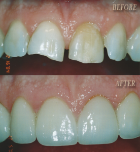 Invisalign result at Colorado Smile Design in Englewood, CO