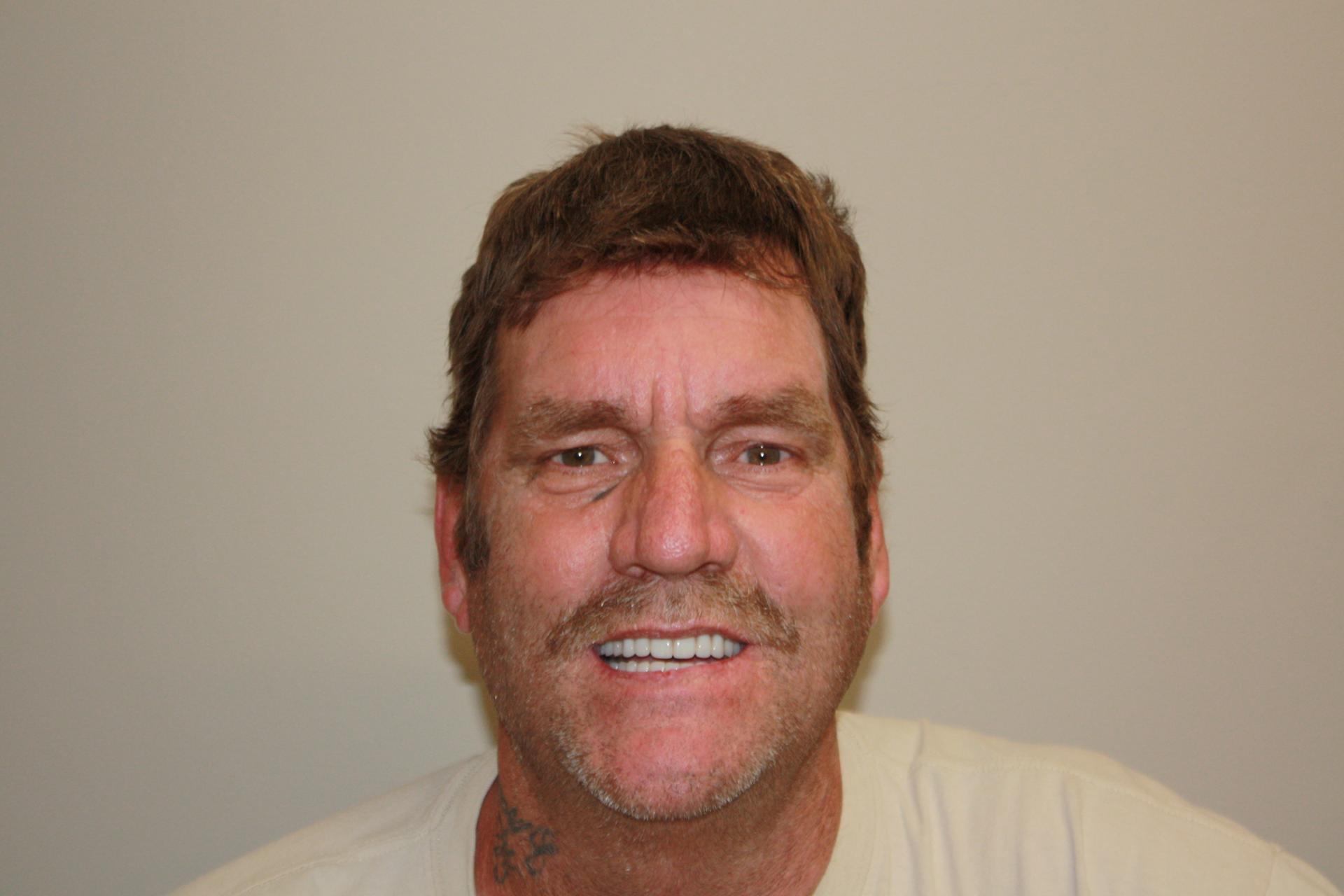 North County Cosmetic and Implant Dentistry smile makeover after — Vista, CA