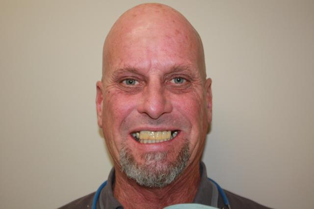 Smile Makeover before at North County Cosmetic and Implant Dentistry in Vista, CA