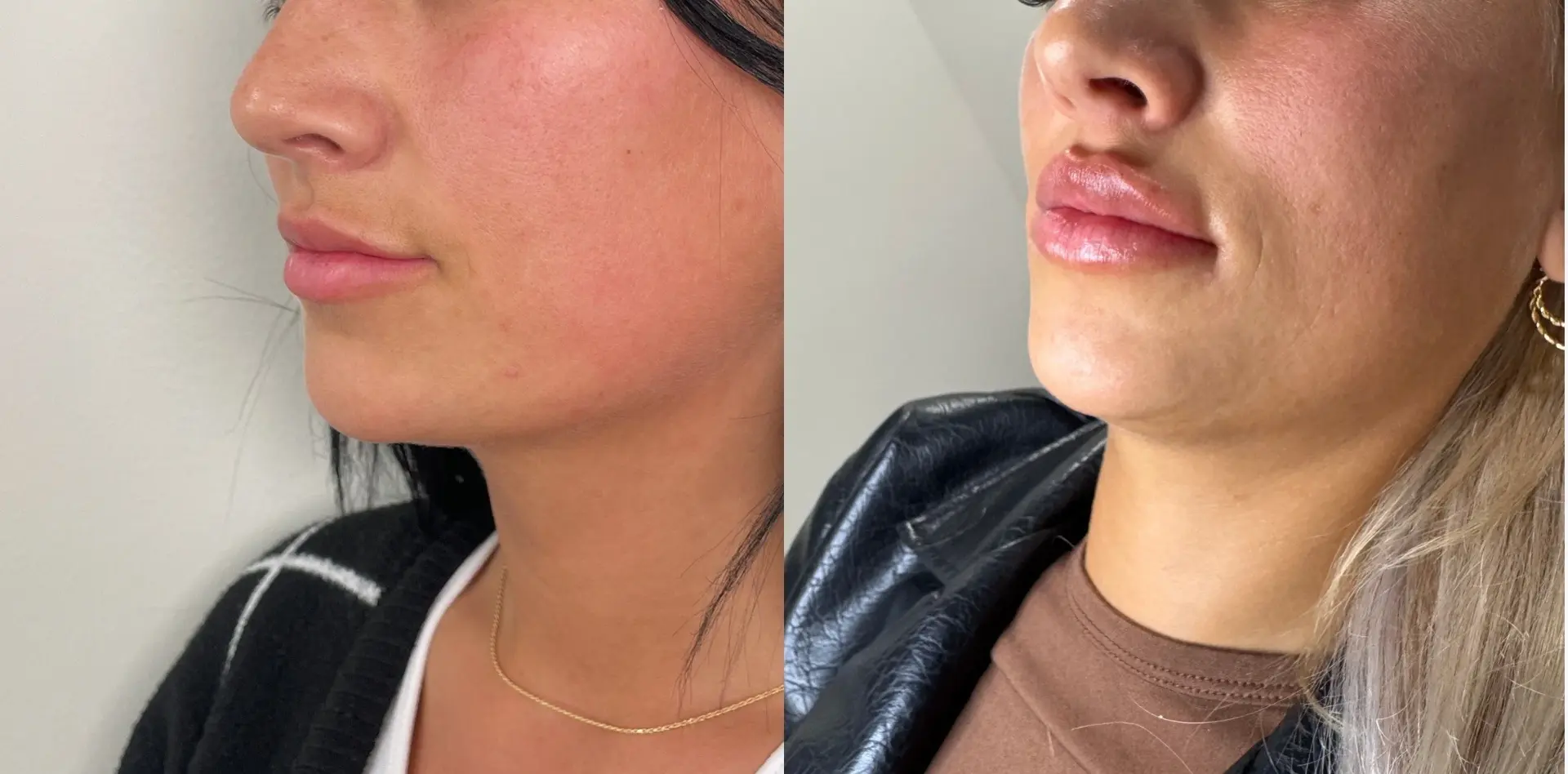 Sola Vie Skin Clinic lip filler result — Providence, RI