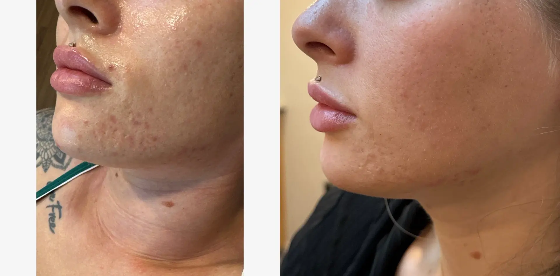 Sola Vie Skin Clinic result — Providence, RI