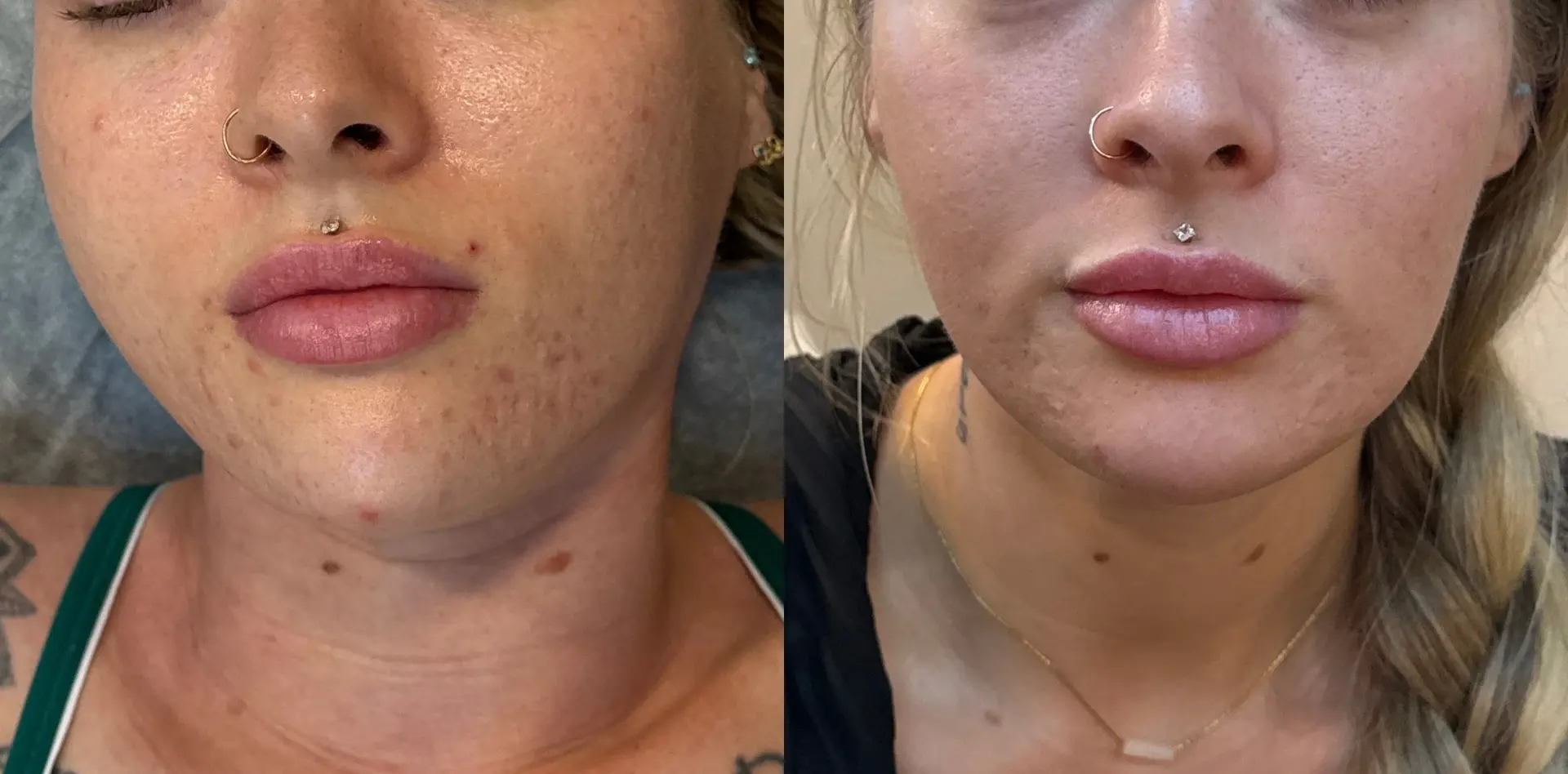 Sola Vie Skin Clinic result — Providence, RI