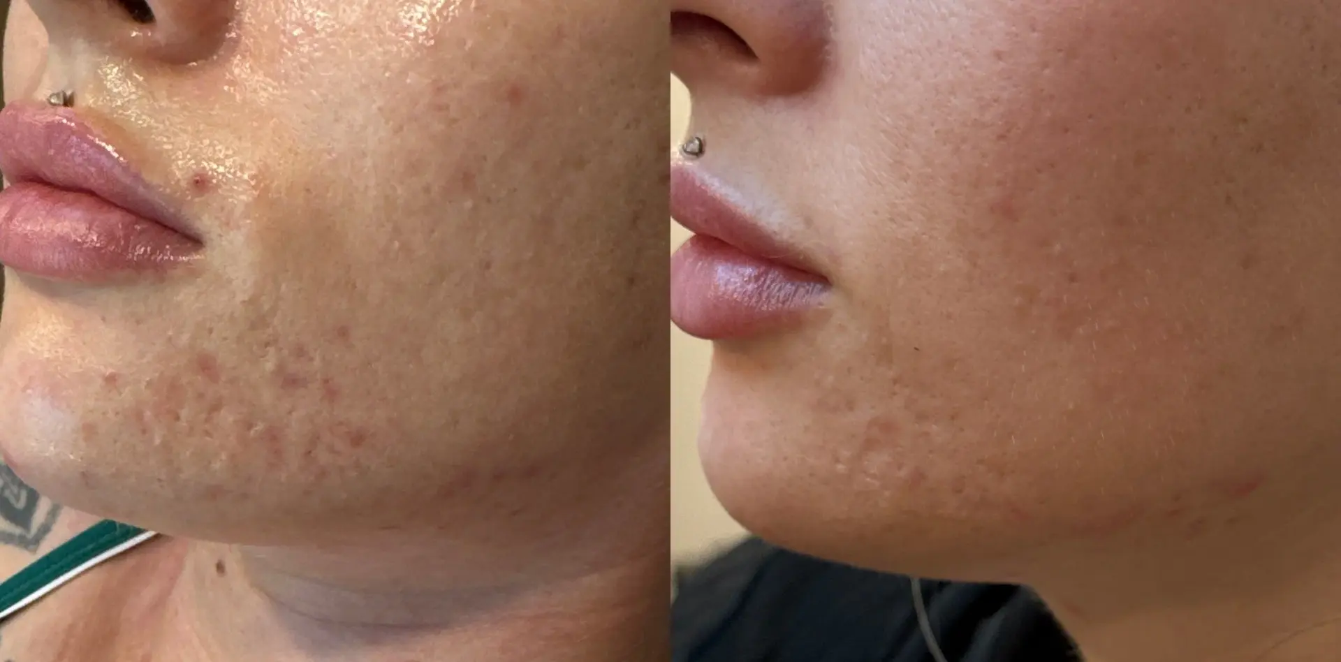 Sola Vie Skin Clinic result — Providence, RI