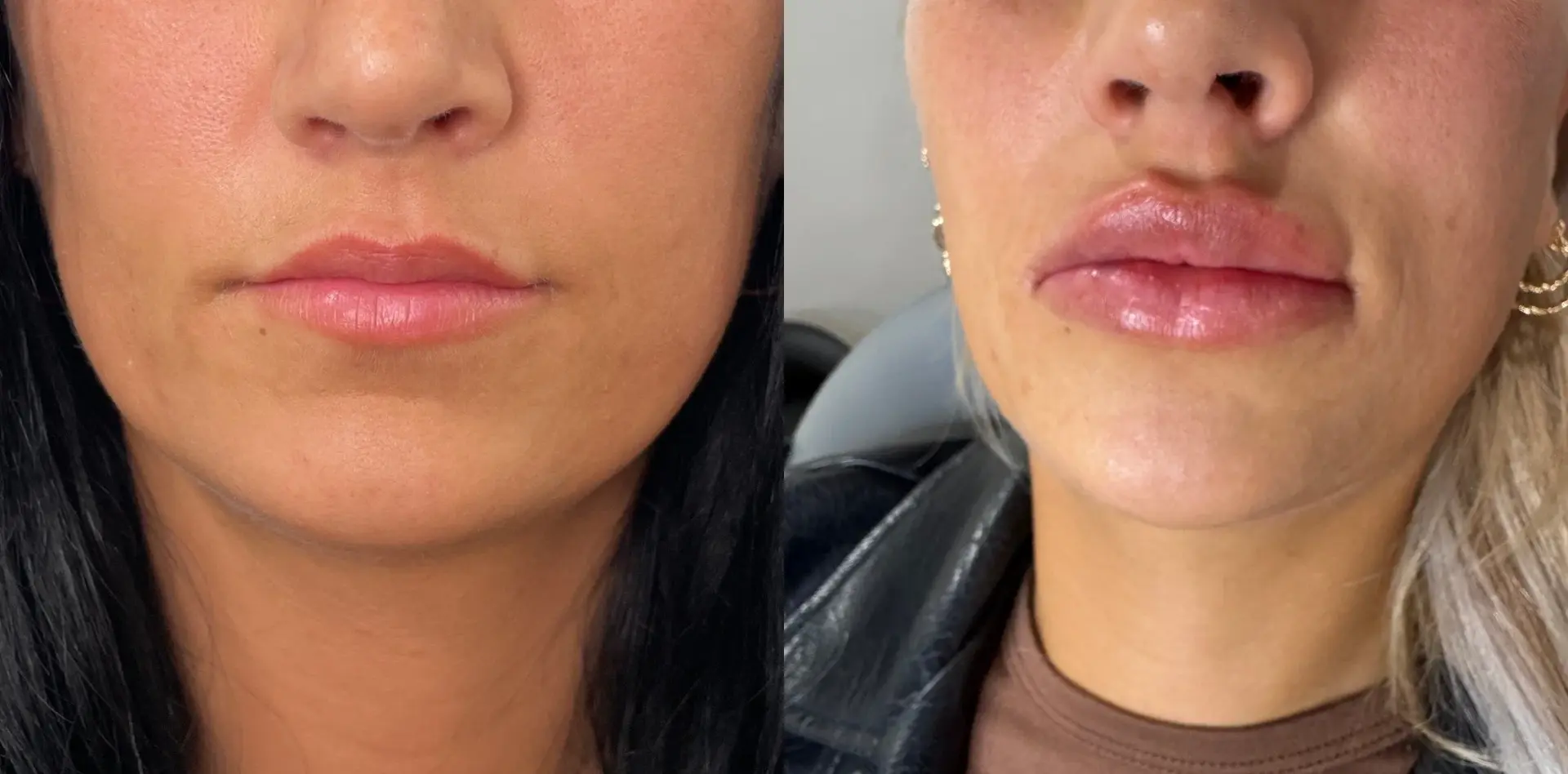 Sola Vie Skin Clinic lip filler result — Providence, RI