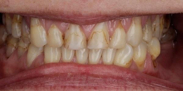 Dental Veneers before at Middle Tennessee Prosthodontics in Brentwood, TN