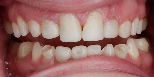 Dental Crowns before at Middle Tennessee Prosthodontics in Brentwood, TN