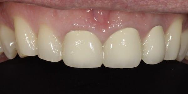 Dental Veneers before at Middle Tennessee Prosthodontics in Brentwood, TN