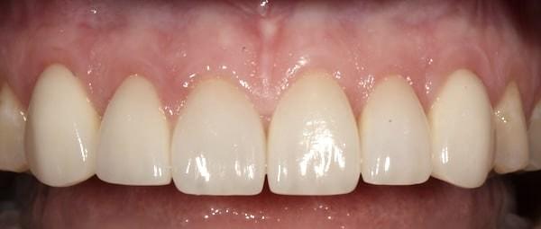 Dental Veneers after at Middle Tennessee Prosthodontics in Brentwood, TN