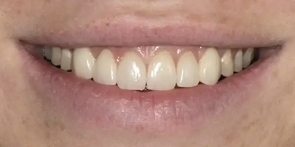 Middle Tennessee Prosthodontics veneers after — Brentwood, TN