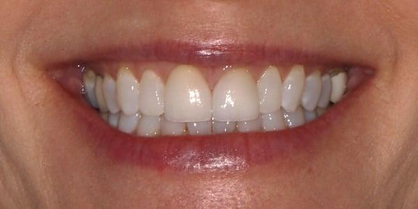 Dental Veneers after at Middle Tennessee Prosthodontics in Brentwood, TN