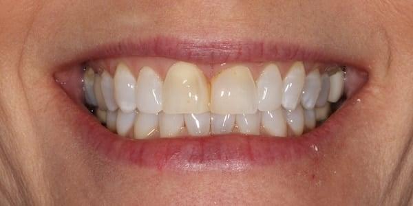Dental Veneers before at Middle Tennessee Prosthodontics in Brentwood, TN