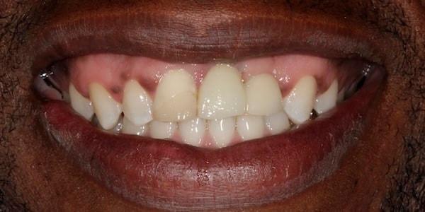 Dental Implants before at Middle Tennessee Prosthodontics in Brentwood, TN