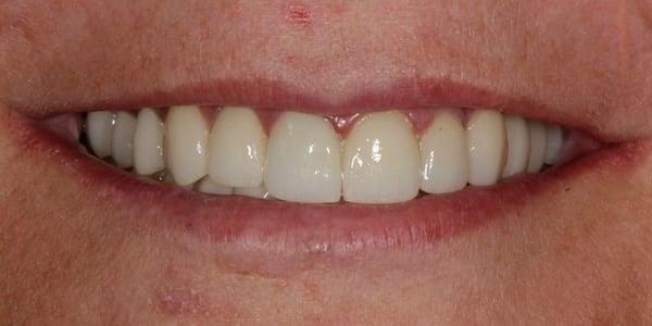 Middle Tennessee Prosthodontics smile makeover after — Brentwood, TN