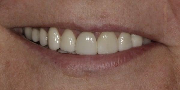 Smile Makeover before at Middle Tennessee Prosthodontics in Brentwood, TN