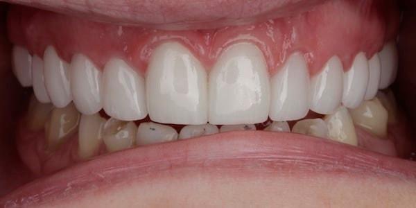 Dental Crowns after at Middle Tennessee Prosthodontics in Brentwood, TN