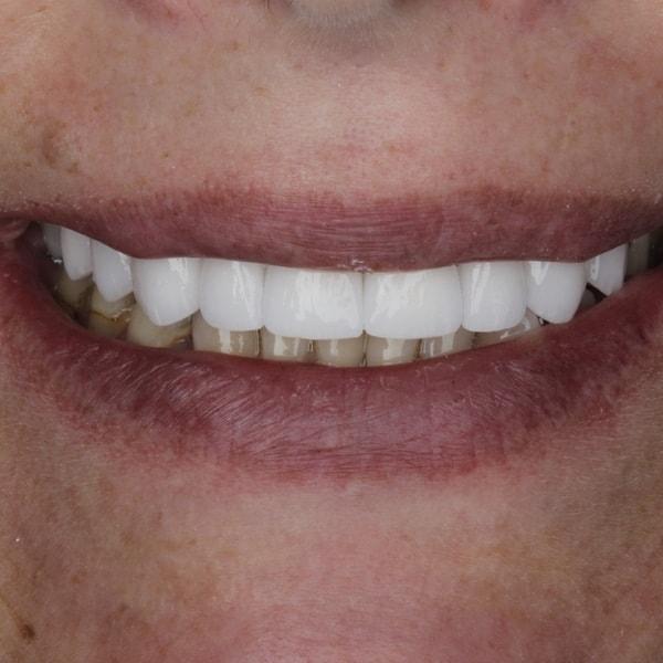 Dental Veneers after at Middle Tennessee Prosthodontics in Brentwood, TN