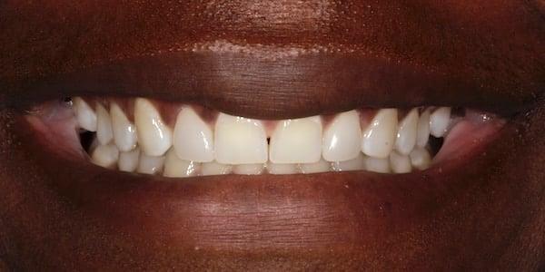 Dental Veneers after at Middle Tennessee Prosthodontics in Brentwood, TN