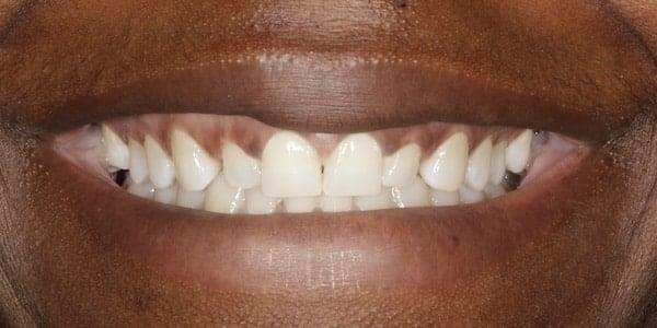 Dental Veneers before at Middle Tennessee Prosthodontics in Brentwood, TN