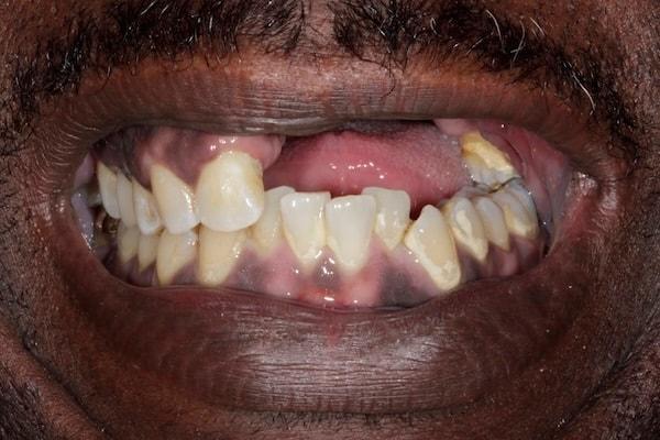 Dental Implants before at Middle Tennessee Prosthodontics in Brentwood, TN
