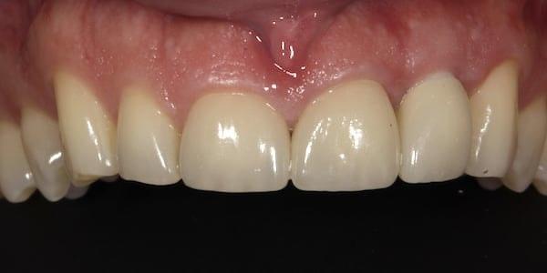 Dental Veneers after at Middle Tennessee Prosthodontics in Brentwood, TN