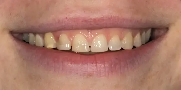 Dental Veneers before at Middle Tennessee Prosthodontics in Brentwood, TN