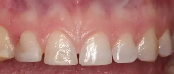 Dental Veneers before at Middle Tennessee Prosthodontics in Brentwood, TN