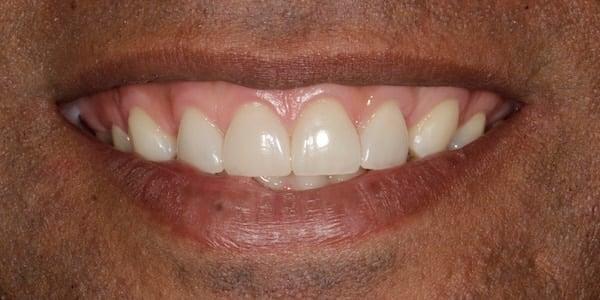 Dental Veneers after at Middle Tennessee Prosthodontics in Brentwood, TN