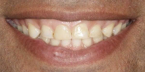 Dental Veneers before at Middle Tennessee Prosthodontics in Brentwood, TN