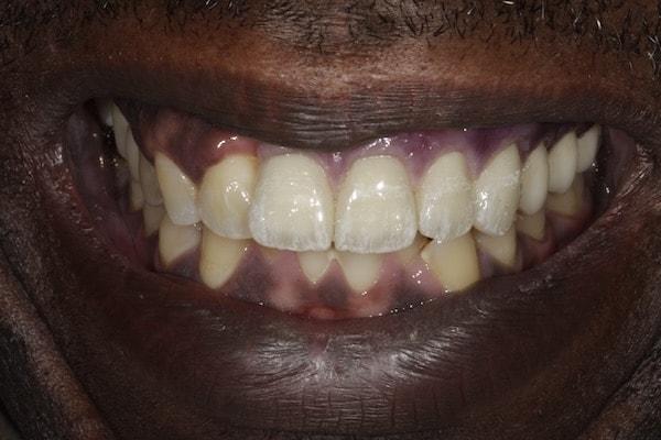 Middle Tennessee Prosthodontics dental implants after — Brentwood, TN